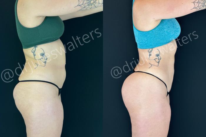 Before & After VASERlipo® Case 201 Right Side View in Metairie and New Orleans, LA