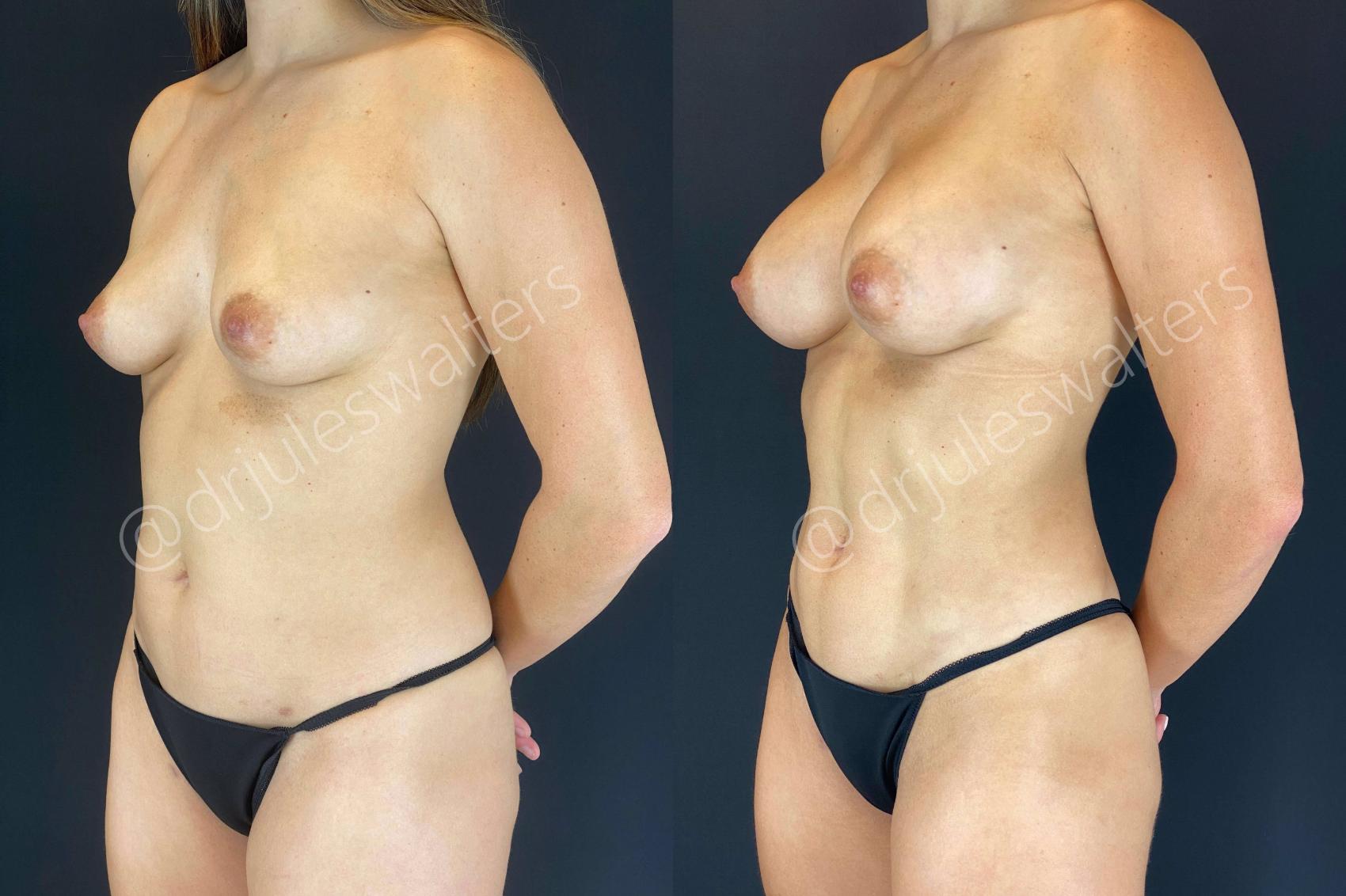 Before & After VASERlipo® Case 53 View #1 View in Metairie, New Orleans, Covington, LA