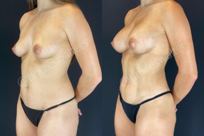 Before & After Breast Augmentation Case 53 View #1 View in Metairie and New Orleans, LA