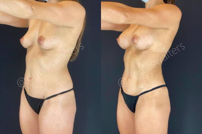 Before & After Liposuction Case 53 View #2 View in Metairie and New Orleans, LA