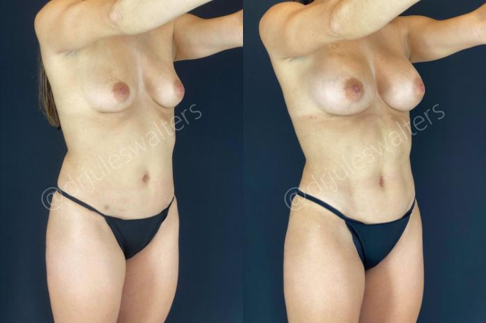 Before & After Hi-Definition Liposuction Case 53 View #4 View in Metairie and New Orleans, LA