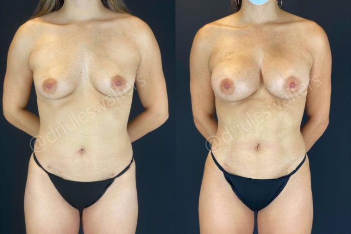 Before & After Liposuction Case 53 View #6 View in Metairie and New Orleans, LA