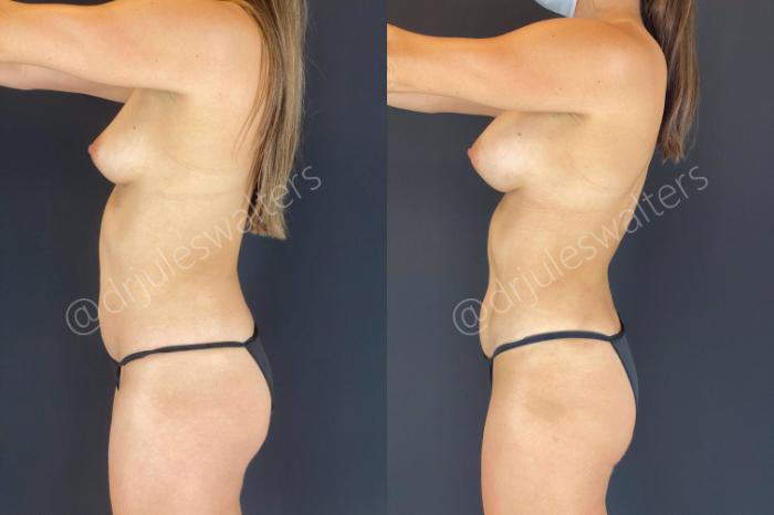Before & After Liposuction Case 53 View #7 View in Metairie and New Orleans, LA