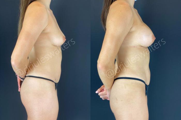 Before & After Breast Augmentation Case 53 View #8 View in Metairie and New Orleans, LA